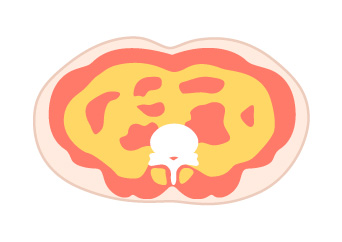 内臓脂肪型