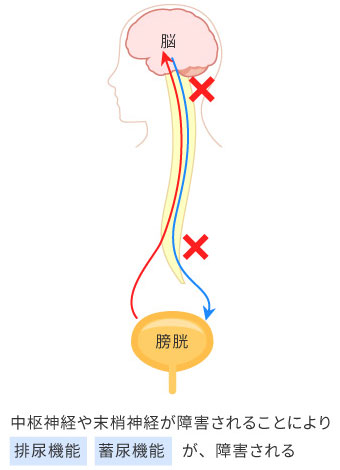 兵庫県神戸市の神経因性膀胱治療｜やまの泌尿器科